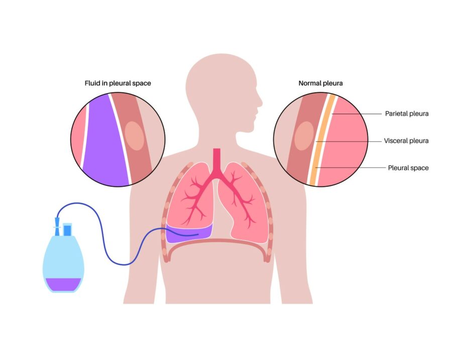 Tunneled pleural catheter