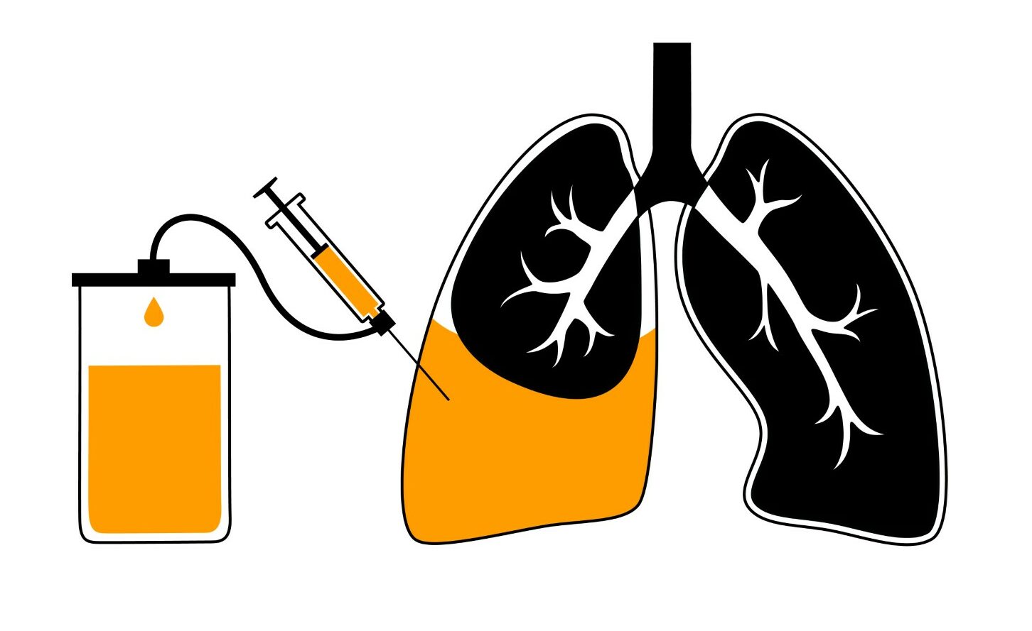 Thoracentesis medical procedure